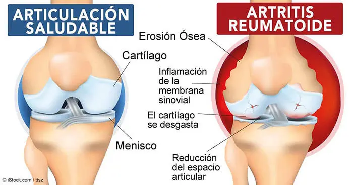 artritis reumatoide