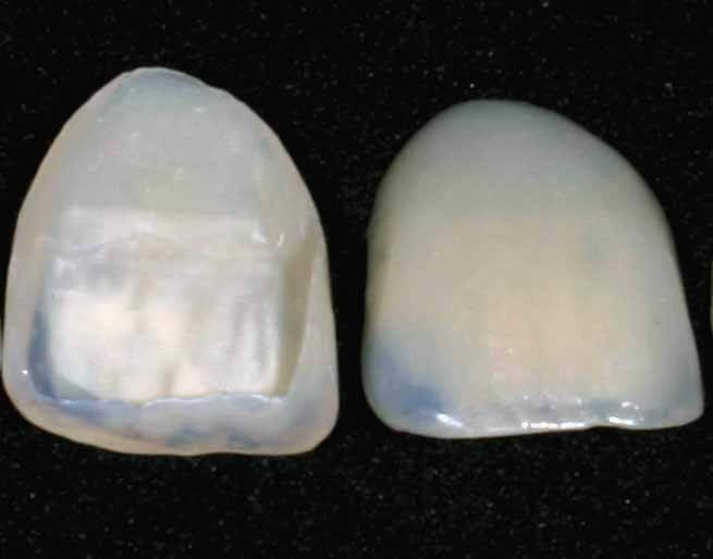 Carillas dentales2