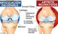 artritis reumatoide