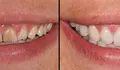 Carillas dentales