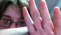 Psoriasis port