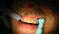 Tooth_polishing_9332 port