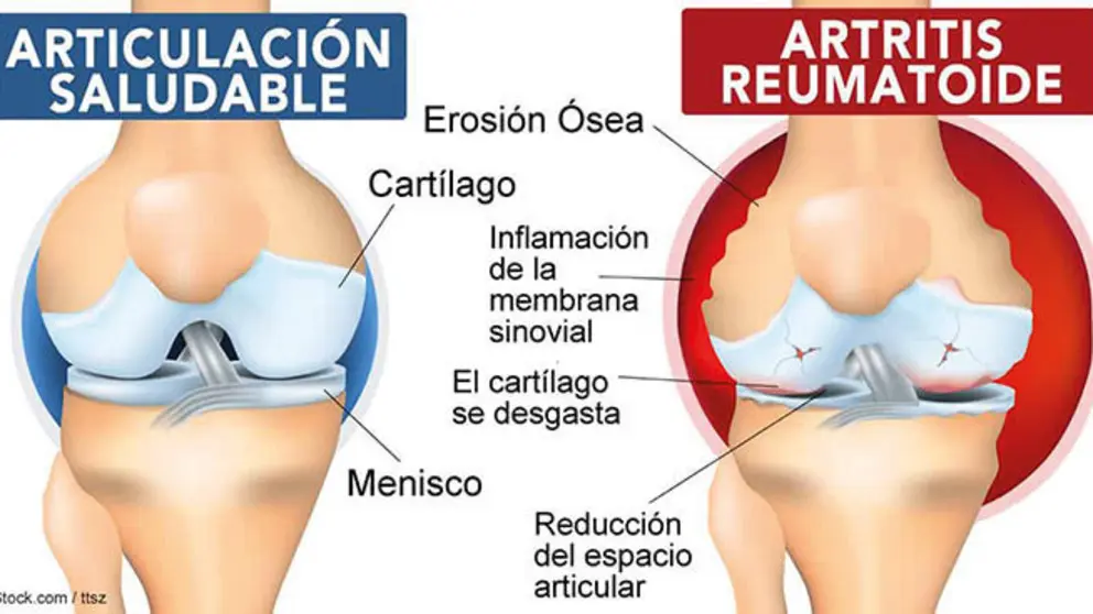 artritis reumatoide