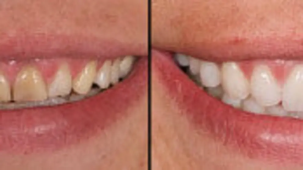 Carillas dentales
