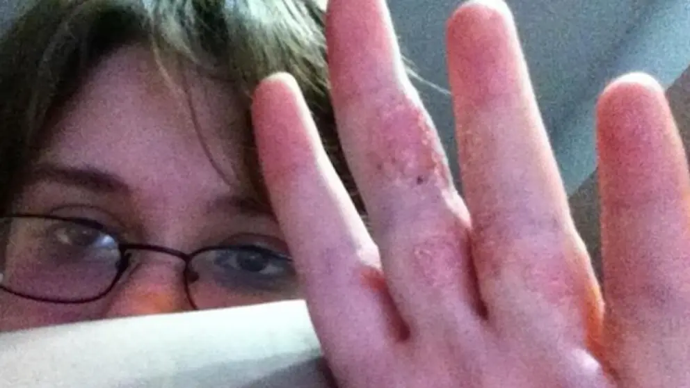 Psoriasis port