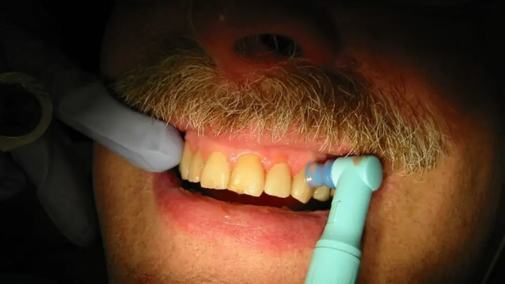 Tooth_polishing_9332 port