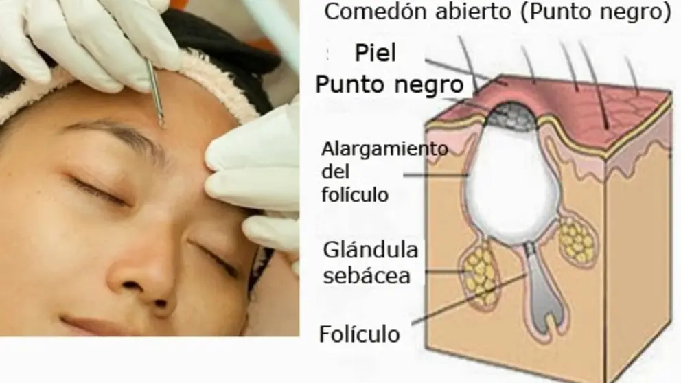 Punto negro
