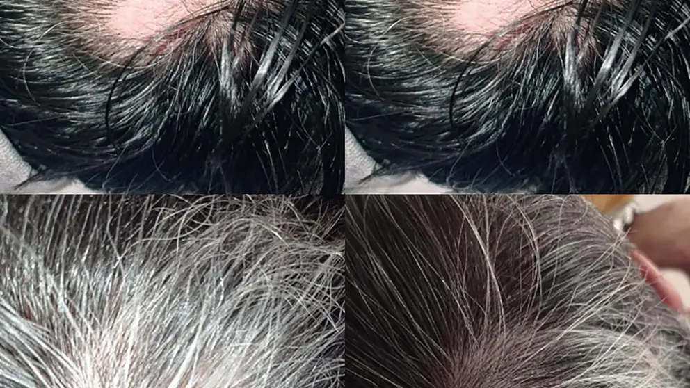 Pelo abundante